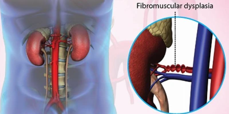 Causes, Symptoms, and Diagnosis of Fibromuscular Dysplasia: A Complete Guide 