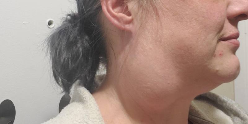 Branchial Cleft Cyst: Explore Its Early Signs and Diagnostic Methods 